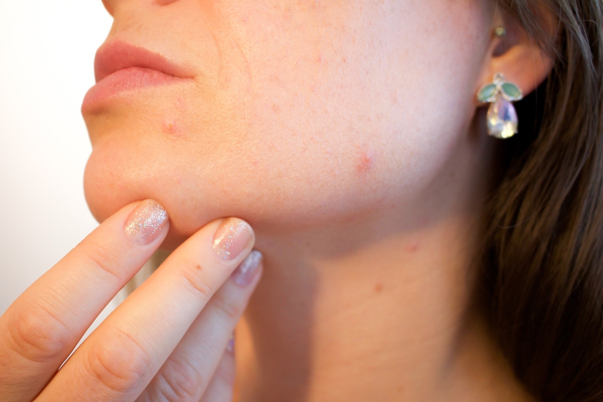 How to Treat Adult Acne